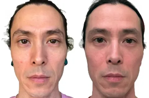 Two front-facing facial photographs with a neutral expression, shown side by side